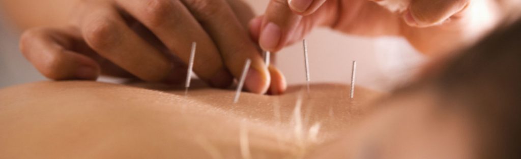 Hender som setter nåler i ryggen til en person. Foto